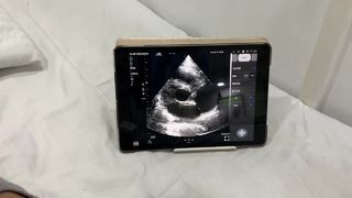 Sonda de ultrasonido inalámbrica de doble cabezal para cardíaco y POCUS