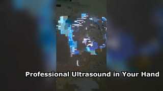 Ultrasonido transvaginal portátil para la ginecología moderna